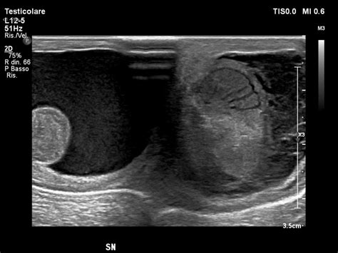 Testicular Trauma Ultrasound