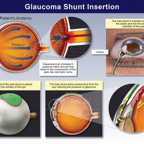 Glaucoma Shunt Insertion - TrialExhibits Inc.