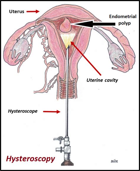 Endometrial Polyps Women S Health By Dr Lee Say Fatt