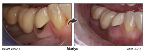 Chao Pinhole Surgical Technique Pst™ Dental Implants And Periodontics