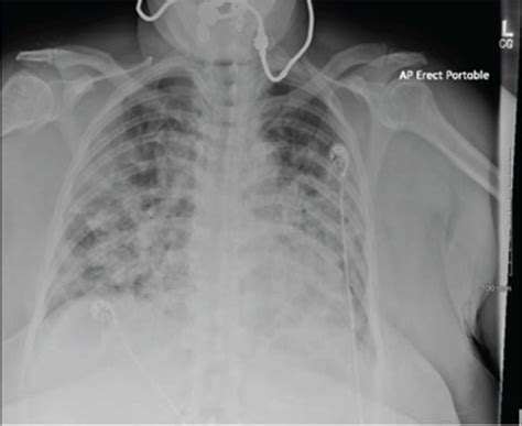 Chest X-ray: bilateral consolidations. | Download Scientific Diagram