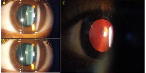 A B Slit Lamp Photograph Of The Left Eye Showing Posterior Lenticonus