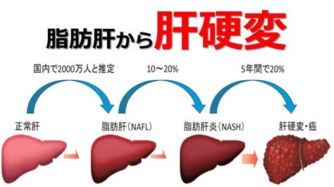 脂肪肝 Nashnafldについて しもやま内科