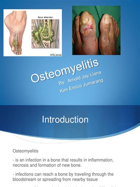 Osteomyelitis Magnetic Resonance Imaging Infection