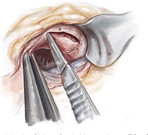 Figure 3 from Transaortic septal myectomy: techniques and pitfalls ...