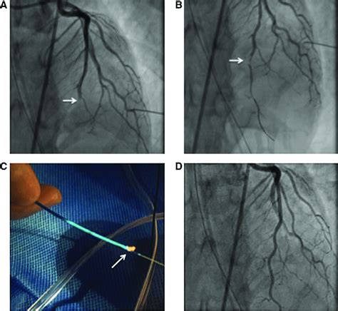 (A) Coronary angiogram showing an occluded (arrow) left anterior ...