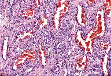 Skin Hemangioma Histology