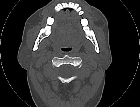 Radiopaedia Case Sialolithiasis Parotid Id 71613 Study 81984 Nc