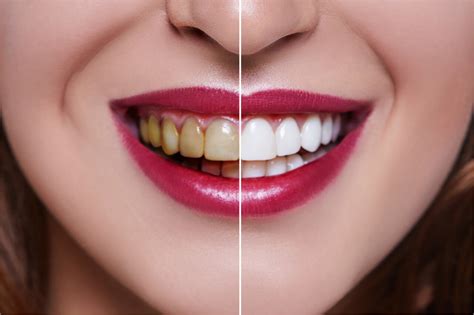 The Top 6 Secrets To Bad Teeth Makeover