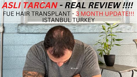 Asli Tarcan 3 Month Update 6 000 Graphs FUE Procedure Istanbul