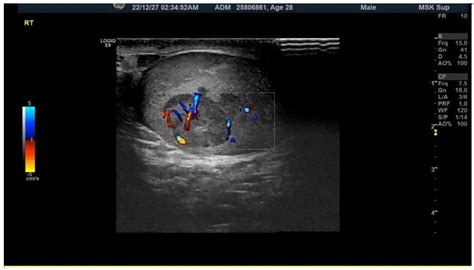 A Case Report Of Intratesticular Hematoma In A Patient With Reiters