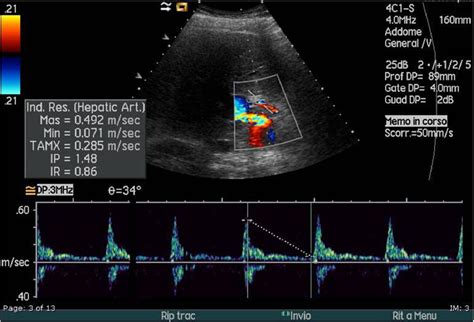 Figure 3 From Role Of Colour Doppler Ultrasonography Cdus In