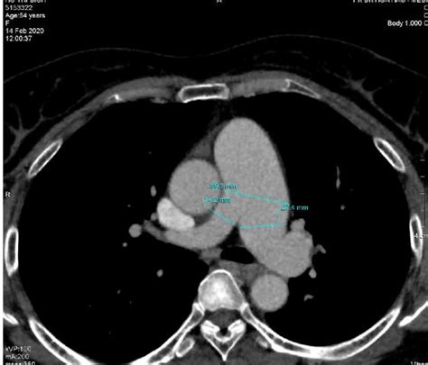 Pulmonary Valvular Endocarditis In The Patient With Pulmonary Stenosis A Case Report With Real