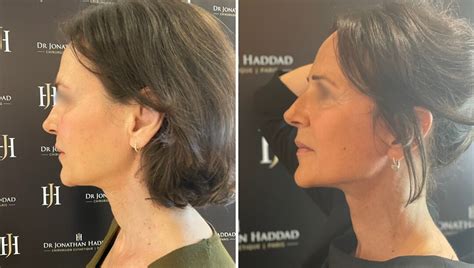 Lifting du visage et du cou cervico facial à Paris Dr HADDAD