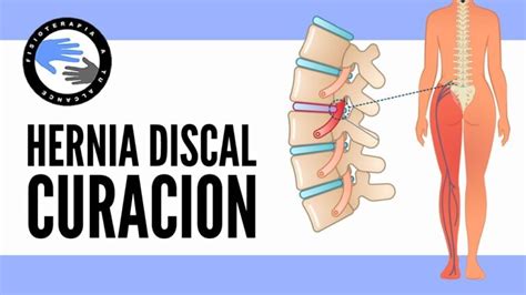 Tratamientos Efectivos Para Una Hernia Discal Sin Cirug A Gu A