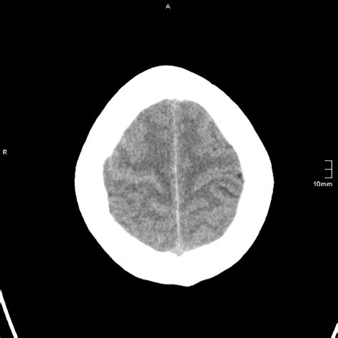 Subarachnoid Haemorrhage Radiology Reference Article Radiopaedia Org