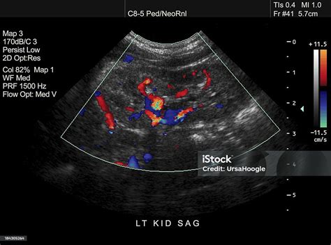 Doppler Ultrasound Of Pediatric Kidney Stock Photo - Download Image Now ...