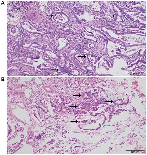 Histopathology Of Lung And Urethra Cancer A Primary Adenocarcinoma