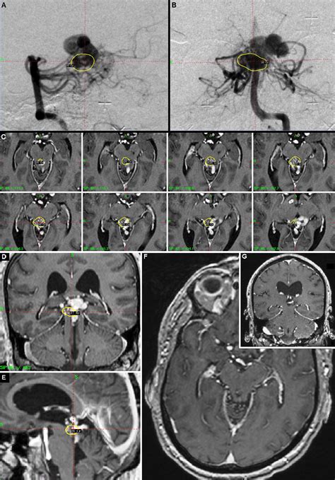 Stereotactic Radiosurgery For Deep Intracranial Arteriovenous Malformations Part 1 Brainstem