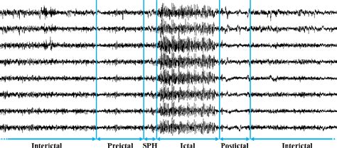 Figure 1 From EEG Based Epileptic Seizure Prediction Using Temporal