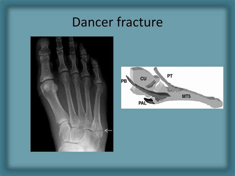 Ppt Radiology Of Fracture Principles Powerpoint Presentation Free