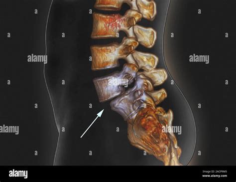 Spondylolisthèse 3D couleur scanner d une section à travers le support