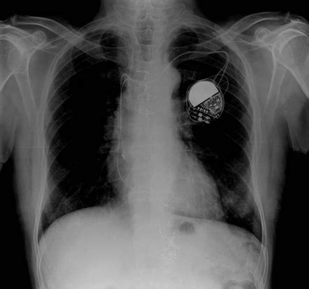 Highly selective vagotomy | Radiology Case | Radiopaedia.org