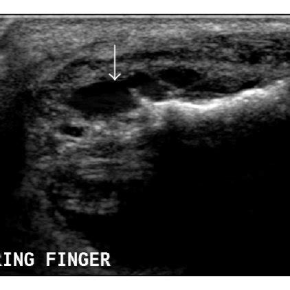 Synovial sarcoma. MRI (of the same patient as Figure 8). On T2W images ...