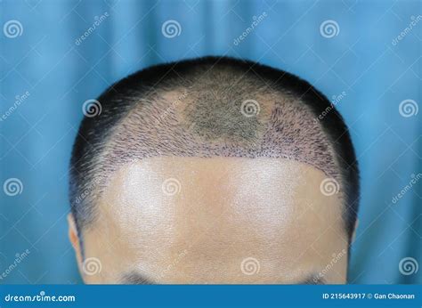 Close Up Top View Of A Man`s Head With Hair Transplant Surgery With A