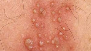 Hiv Rash Pictures Symptoms Treatment Causes