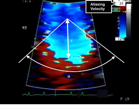 Figure From Evaluation Of Mitral Valve Area By The Proximal