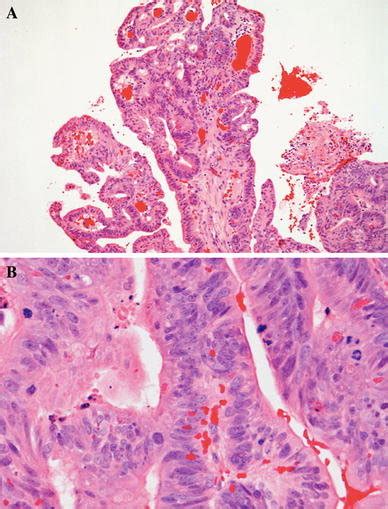 A Intestinal Type Adenocarcinoma Papillary Growth Pattern The Pattern