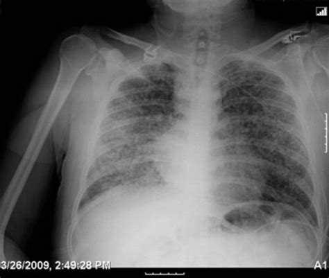 Miliary Pattern On Chest Radiography Tb Or Not Tb Abstract Europe Pmc