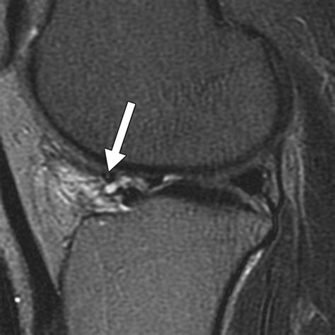 Association Of Parameniscal Cysts With Underlying Meniscal Tears As