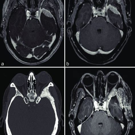 Case 1 Hematoxylin And Eosin Staining Showing Rhabdoid Meningioma 20