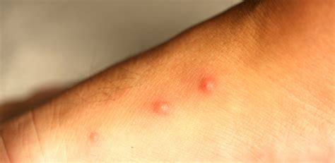 puce de lit  paris conseils pour la reconnaitre  leliminer