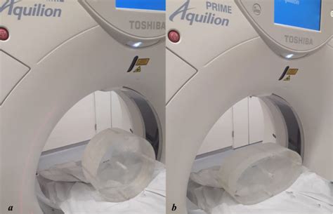 Dosimetry And Protocol Optimization Of Computed Tomography Scans Using Adult Chest Phantoms