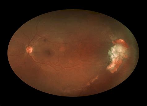 Sickle Cell Retinopathy Photograph By Paul Whitten Pixels