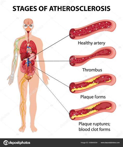 Stages Atherosclerosis Information Infographic Illustration Stock