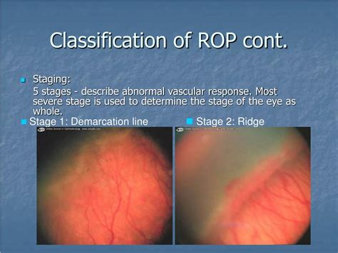 PPT Retinopathy Of Prematurity ROP PowerPoint Presentation Free