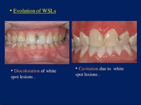 White Spot Lesions