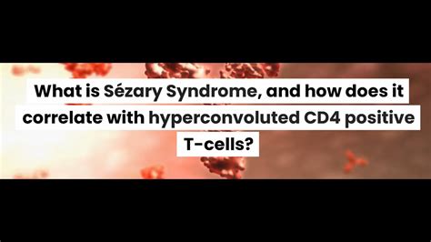 What is Sézary Syndrome and how does it correlate with hyperconvoluted