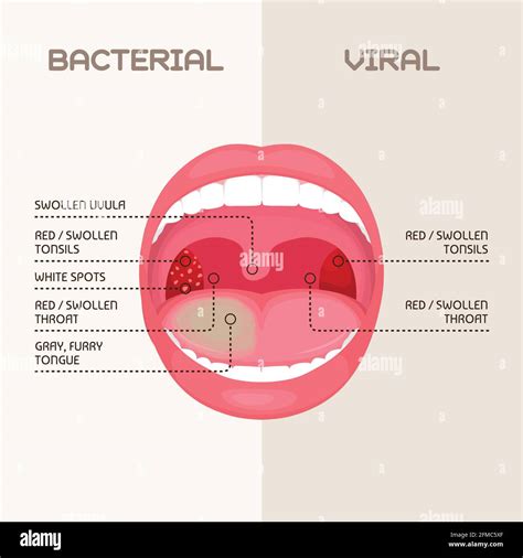 Strep a infection Stock Vector Images - Alamy