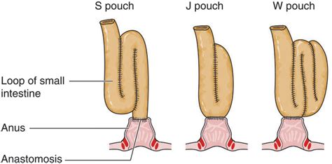 Surgical Management Of Ulcerative Colitis And Crohn S Disease Surgery