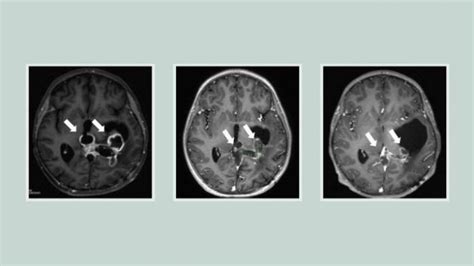 Nuevo F Rmaco Arroja Esperanza En Gliomas Difusos