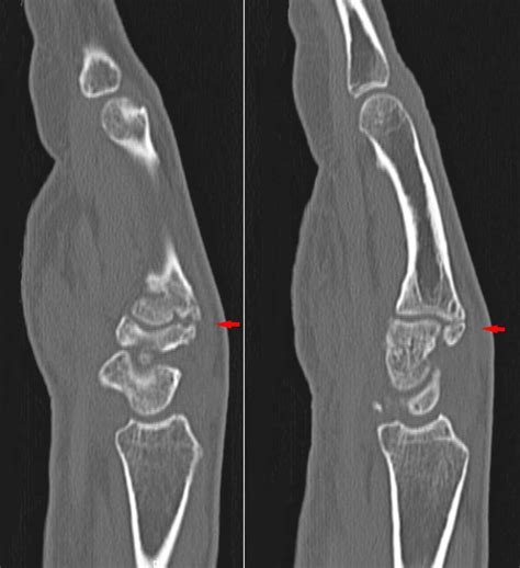 Carpal Boss Wrist Treatment: Consultation, Surgery | Ali Phillips