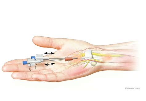 Carpal Tunnel Injection Ultrasound