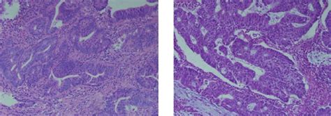 Histological Appearance Of Ascending Colon Mass A Hematoxylin And Download Scientific