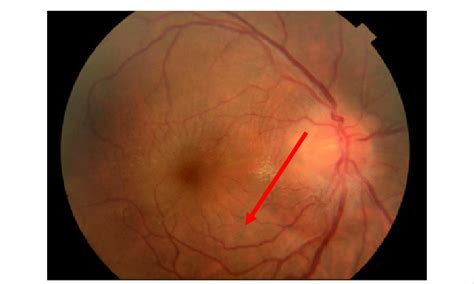 Fundus evaluation showed a grade II papillary edema with macular... | Download Scientific Diagram