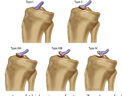 Tibial Intercondylar Eminence